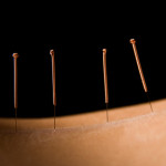 TCM & Acupuncture Treatments